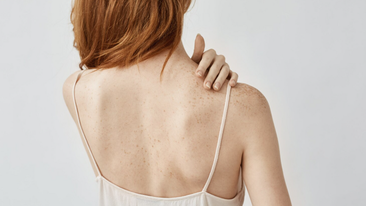 Сначала Анна Садовски принимала сыпь и усталост...