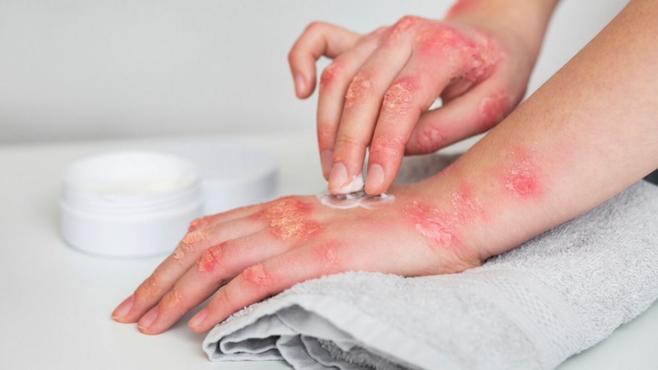 Исследование PNAS показало, что псориазоподобно...