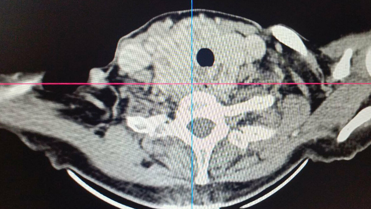 Зоб угрожал сердечно-сосудистой системе  пациентки