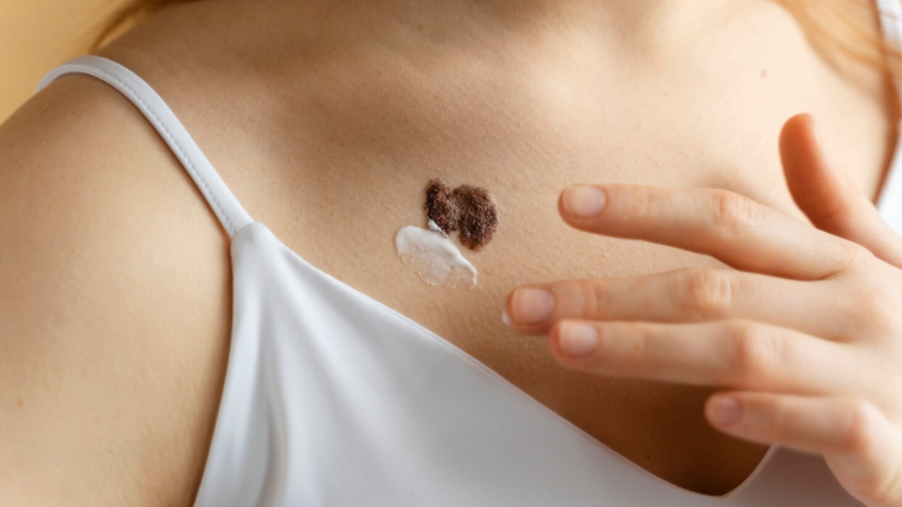 Найдена генетическая причина хронических плоских бородавок у некоторых людей Ученые выяснили, что поломка гена ITGAL нарушае...