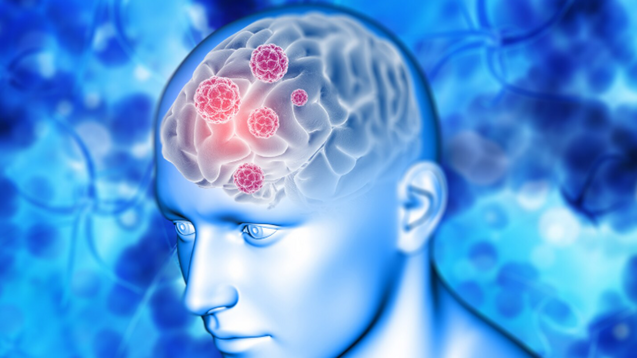 Глиобластома остаётся одним из самых тяжёлых он...