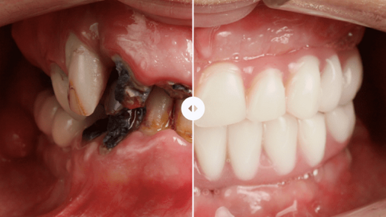 Имплантация All-on-4 в Тольятти: несъёмные зубы...