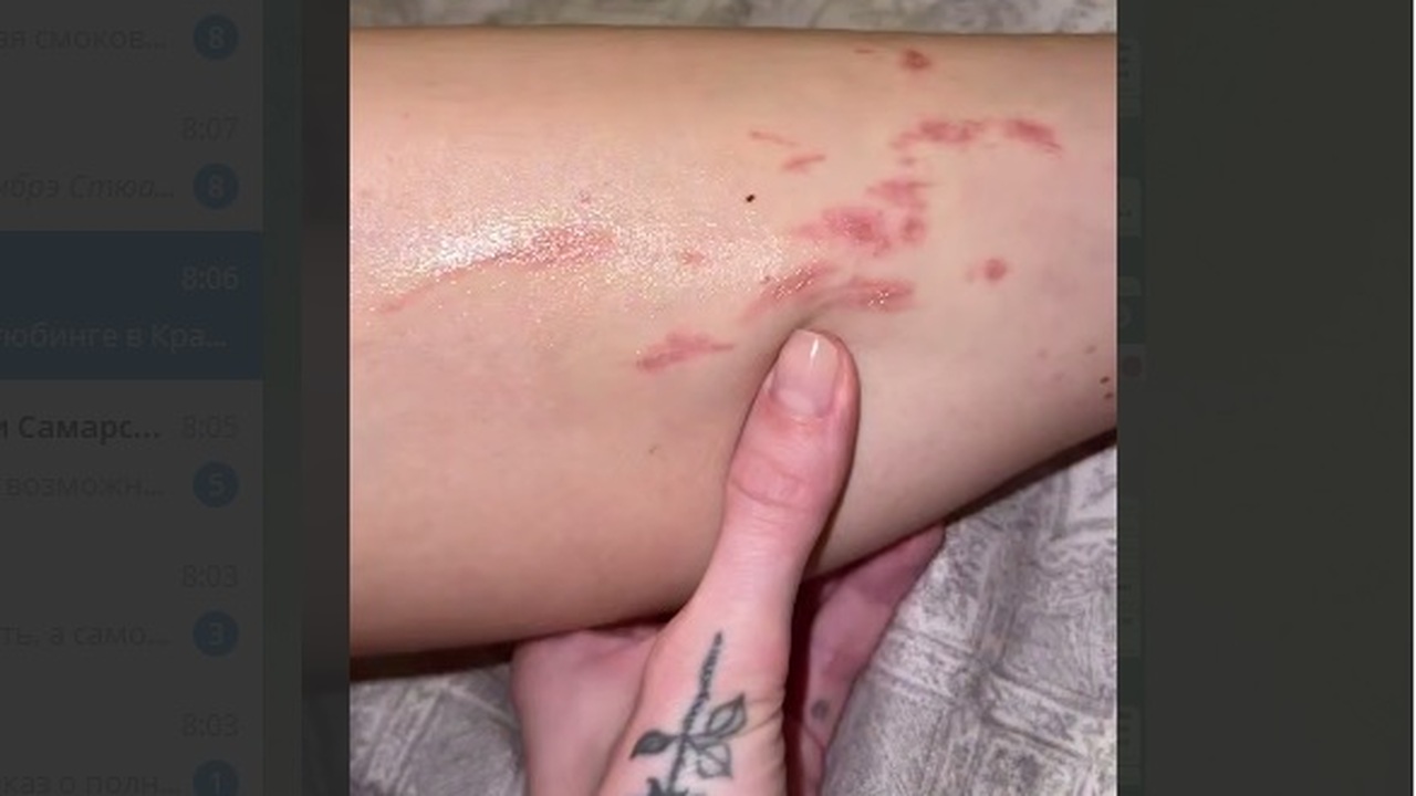 Жительница Самары получила ожоги после неудачной процедуры эпиляции Салон красоты пытается возложить ответственност...