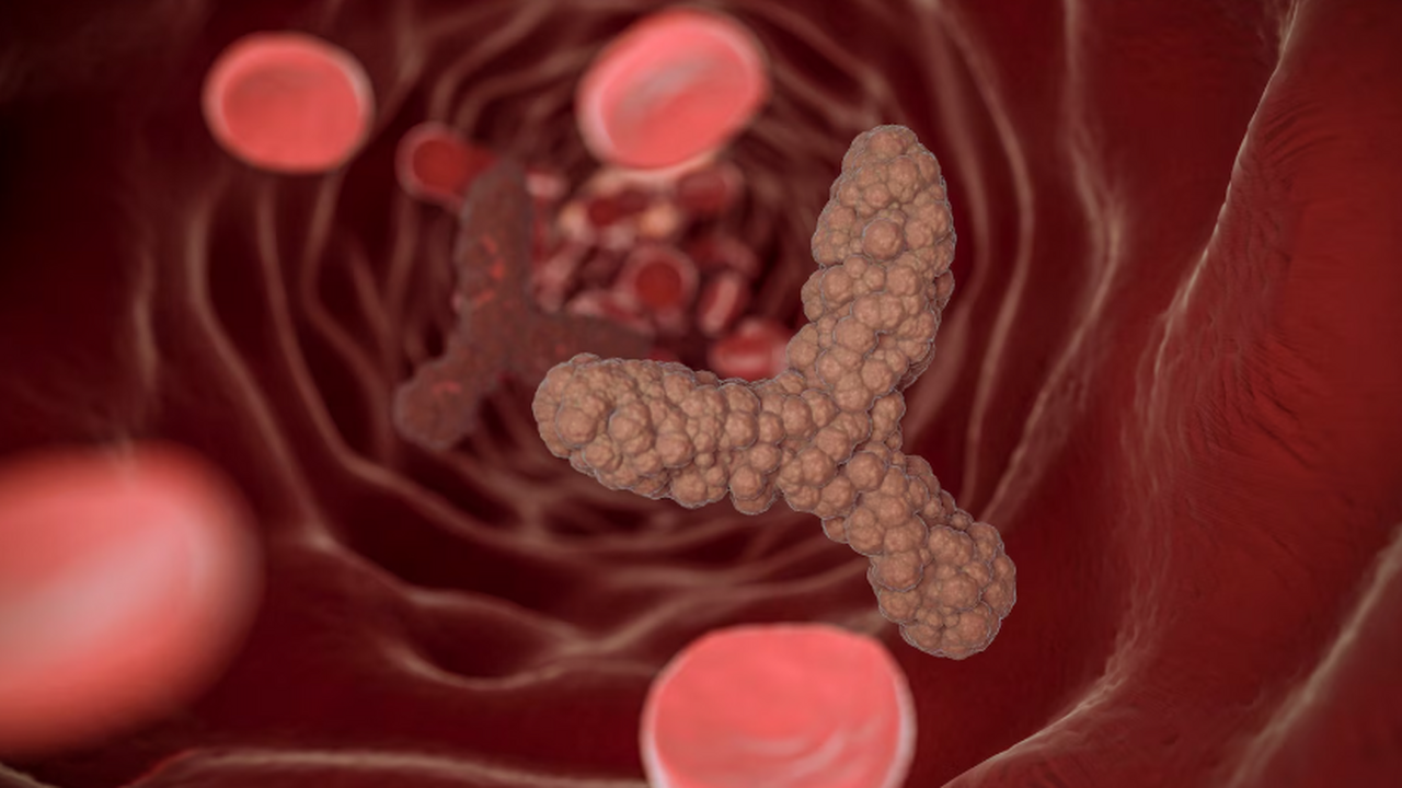 Атеросклероз, сопровождающийся образованием жир...