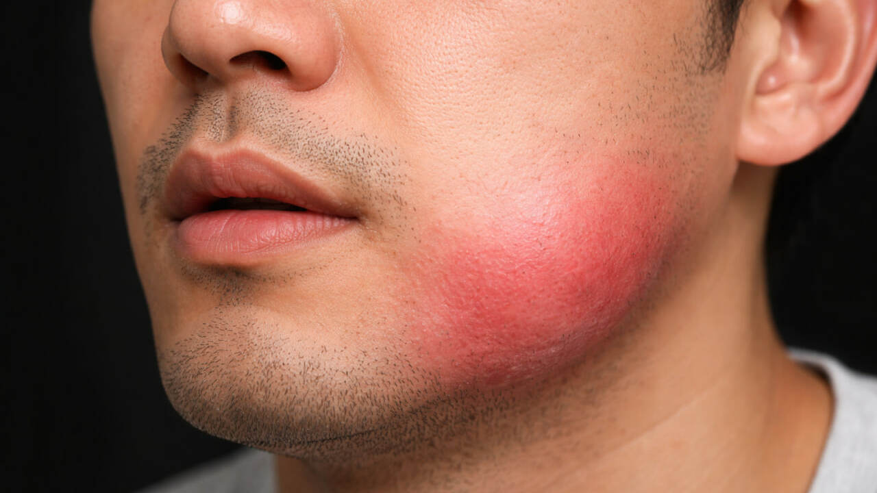 Врачи описали случай синдрома SAPHO, начавшегос...