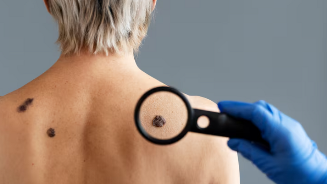 Первые пациенты с меланомой получат отечественную мРНК-вакцину в 2026 году Российские пациенты с меланомой смогут пройти л...