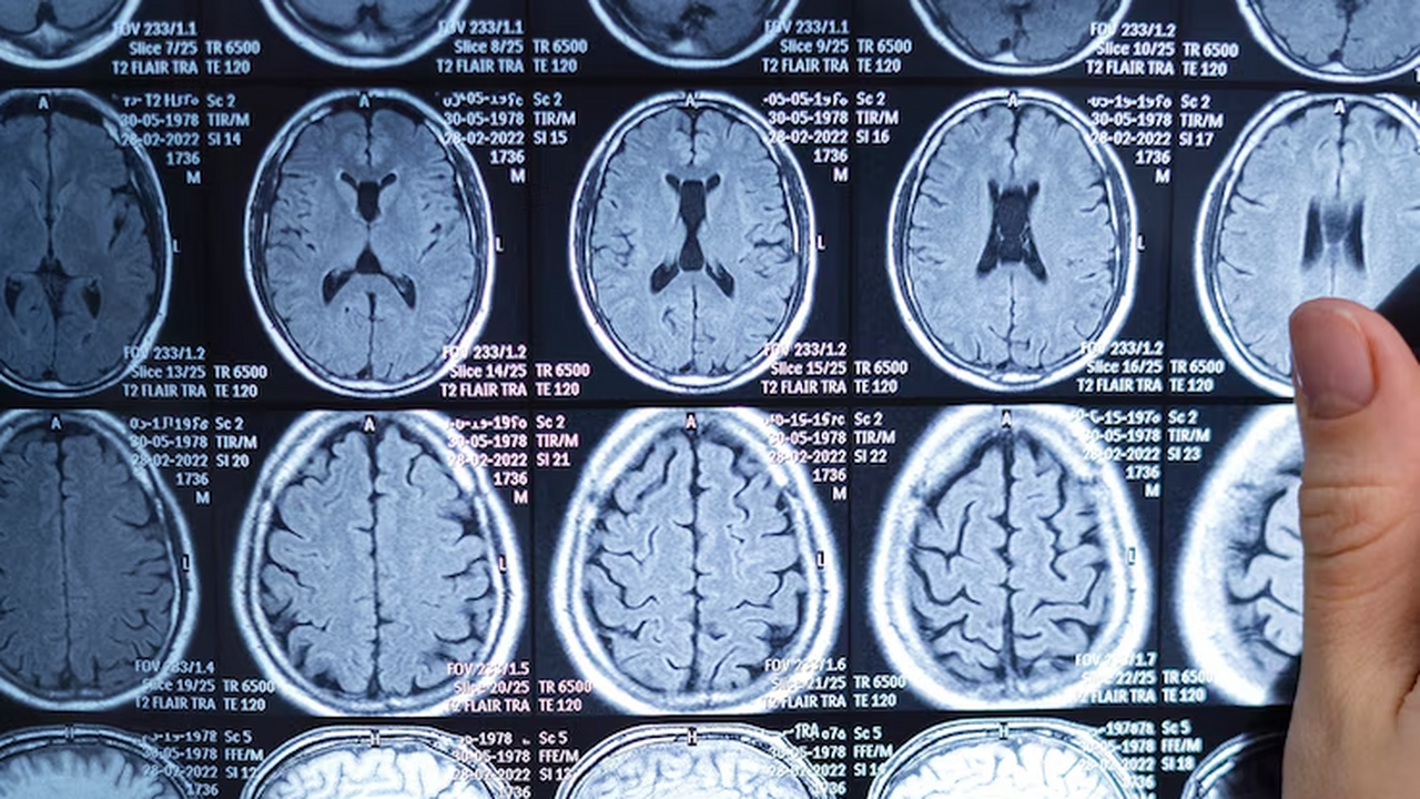 Nat Neurosci: Лемборексант предотвращает нейродегенеративные заболевания мозга Лемборексант предотвращает нейродегенеративные ...