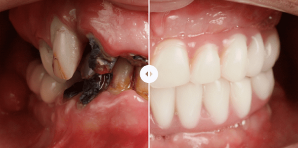 Имплантация All-on-4 в Тольятти: восстановление...